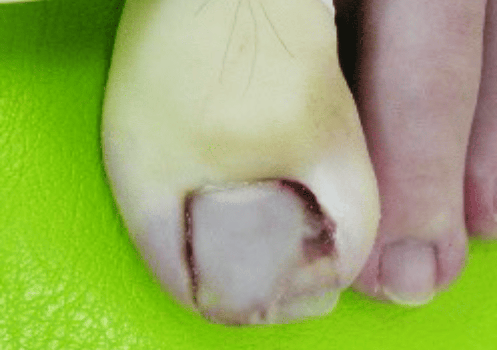 アクリルによる人工爪を形成し、爪の食い込みを改善させました_陥入爪症状写真2
